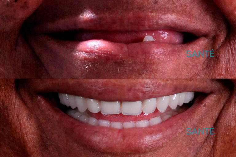 Dentadura e a Perda de Dentes