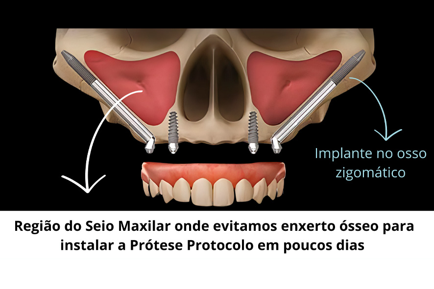 Implante Zigomático - Protocolo sem enxerto ósseo