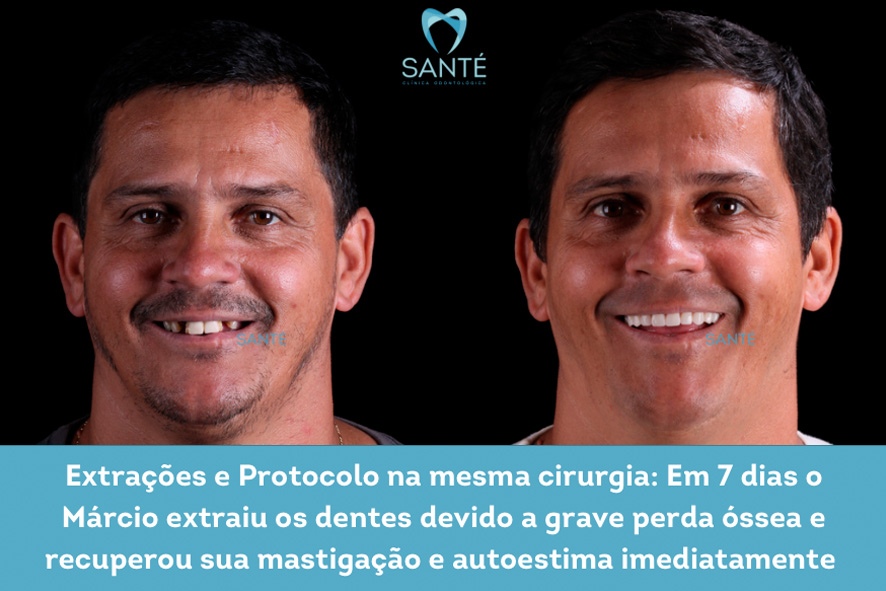 Dentadura Fixa antes e depois Belo Horizonte - BH