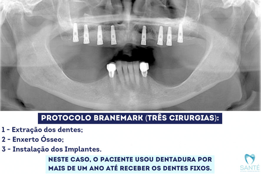 Protocolo Branemark Enxerto Ósseo