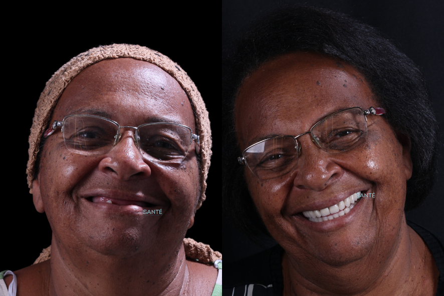 Antes e depois Overdenture