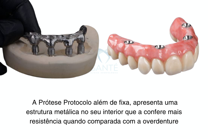 Overdenture Protocolo