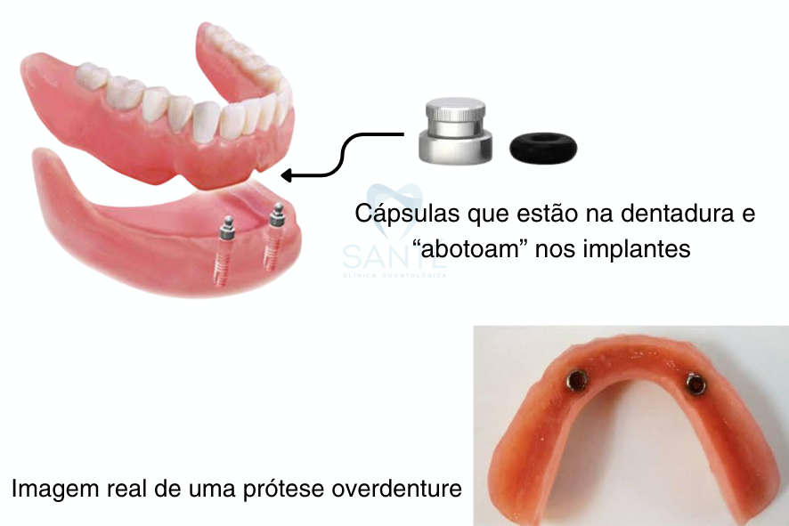 Overdenture dentadura dois pinos