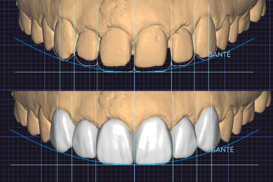 distema espaço entre os dentes facetas