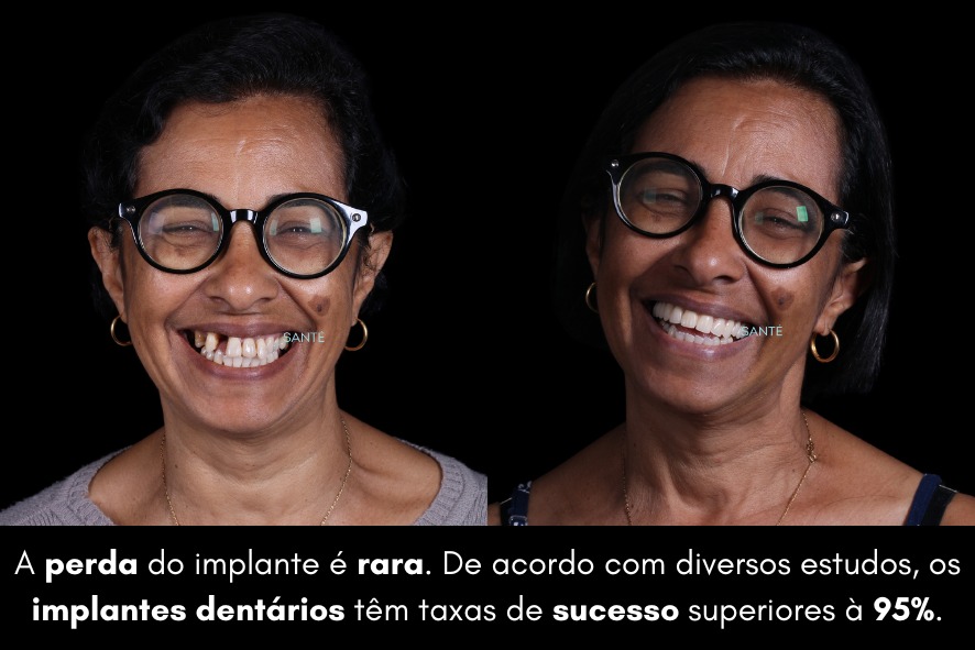 Rejeição implante dentário Belo Horizonte