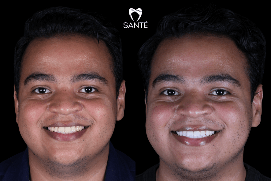 antes e depois clareamento dentario dos dentes