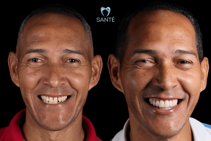 antes e depois facetas de resina