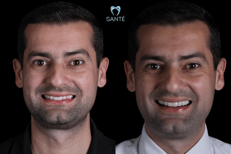 antes e depois lentes de contato dental