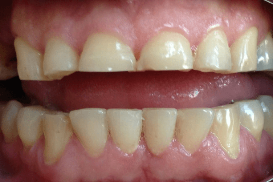 bruxismo desgaste dente bh