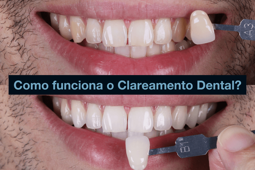 clareamento dentario bh antes e depois