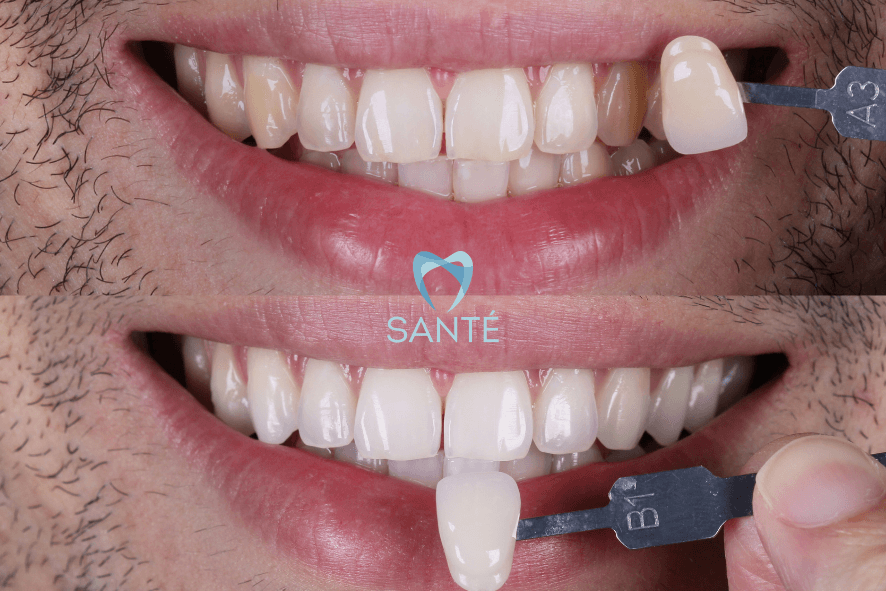 claremento dentario quando custa em bh