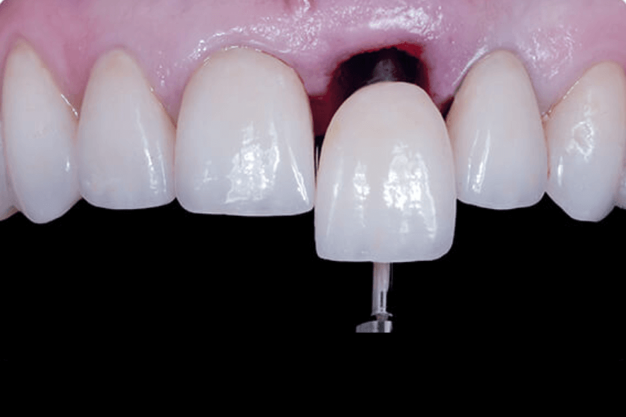 coroa sobre implante belo horizonte bh