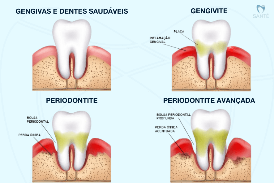 doenca na gengiva e mau halito