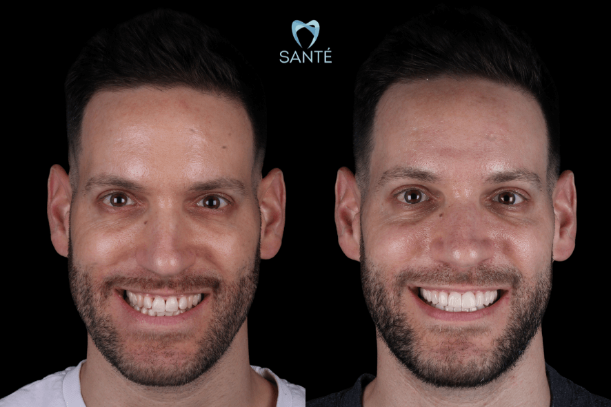 facetas nos dentes belo horizonte