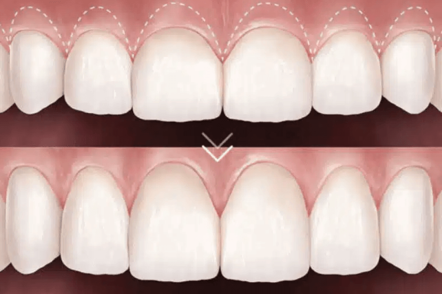 genvivoplastia e gengivectomia em belo horizonte bh