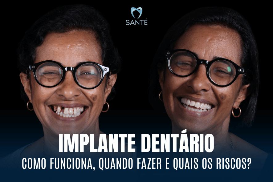 implante dentario em belo horizonte