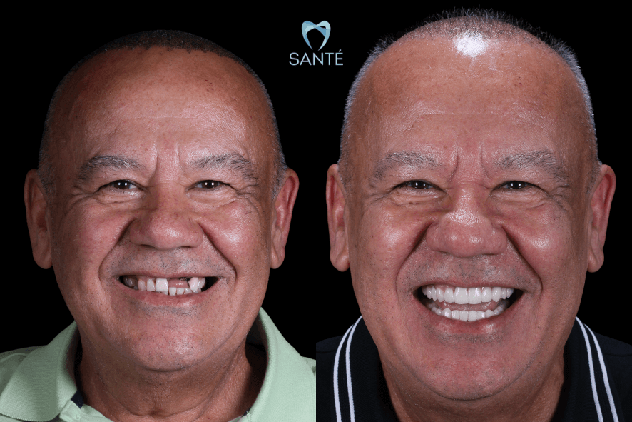 implante dente da frente bh