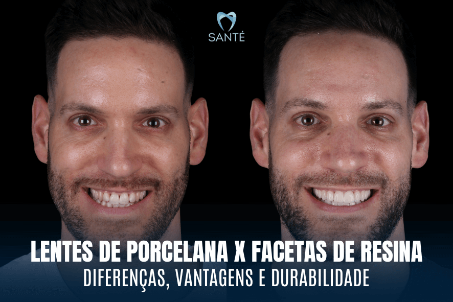 lentes de porcelana belo horizonte bh