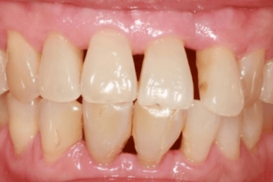 perda ossea em belo horizonte bh