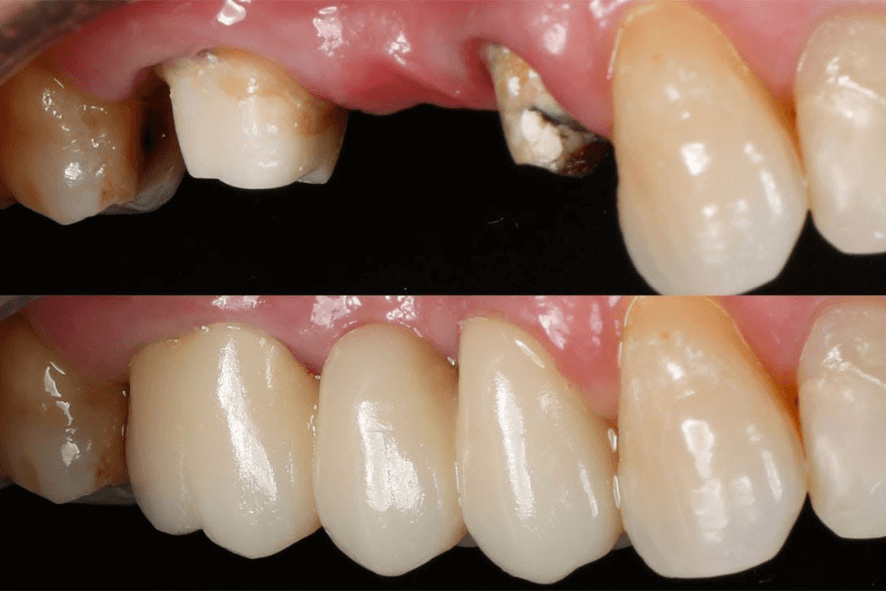 ponte fixa sobre dentes belo horizonte bh