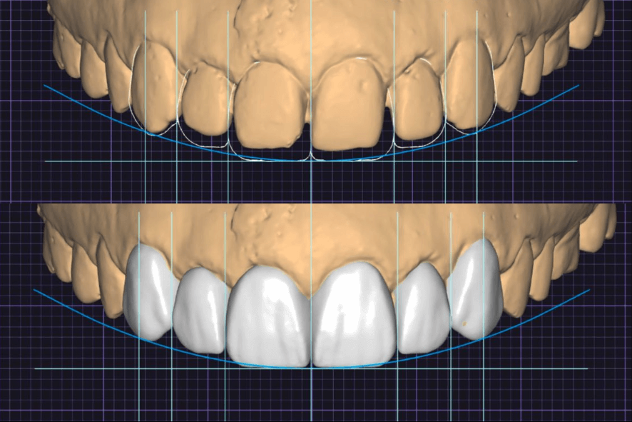 porcelana de zirconia