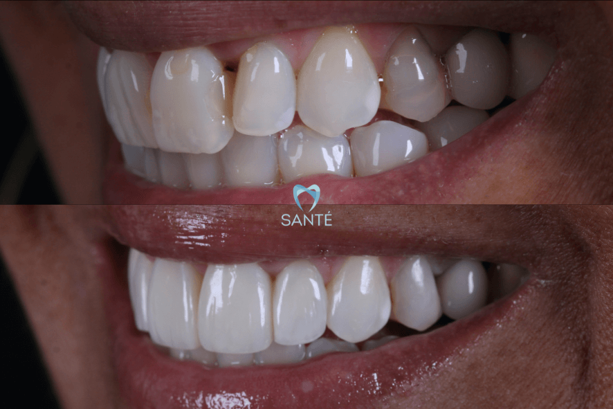 preço claremento dentario