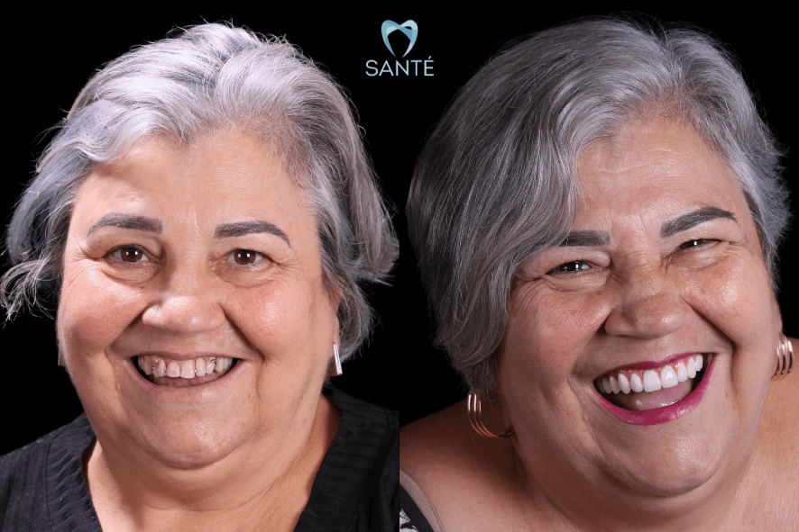 preço implate dentario belo horizonte bh