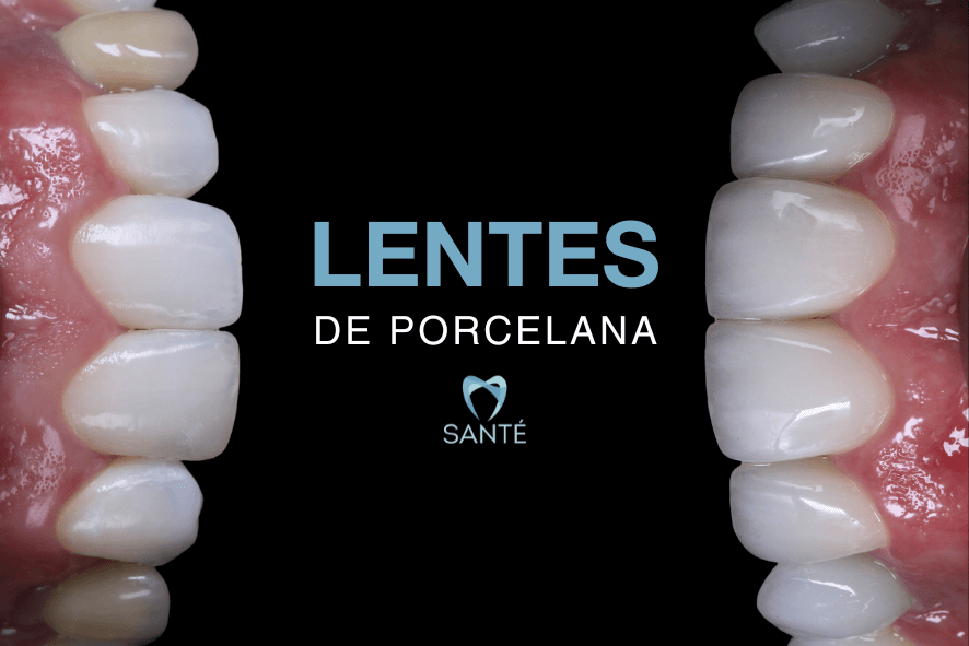 preço lentes de porcelana