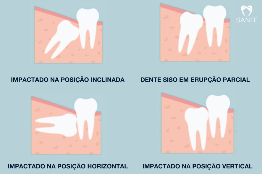 siso impactado em bh