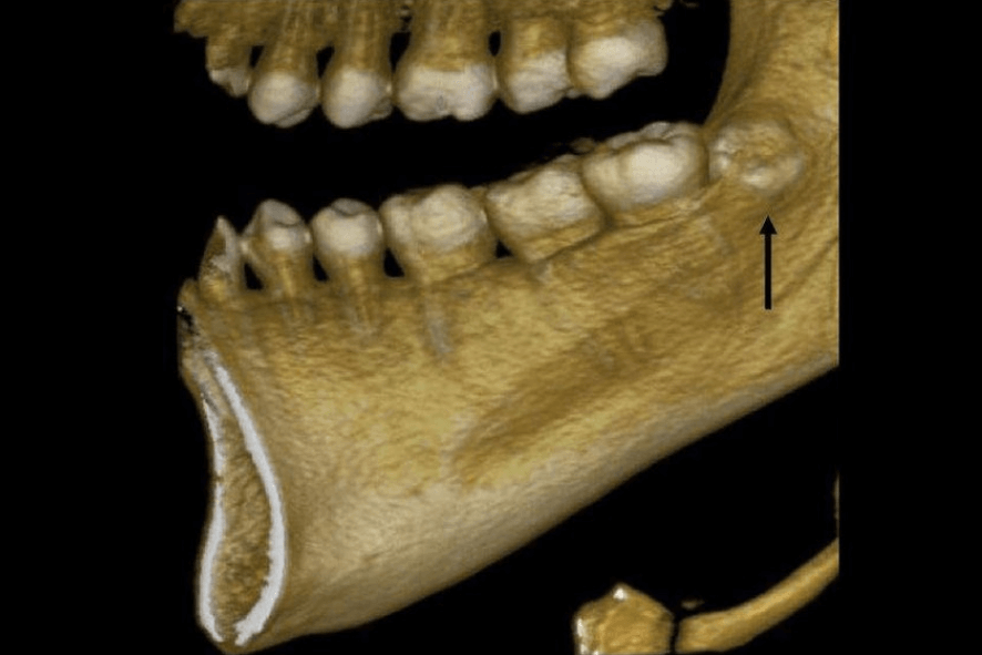 tomografia dente siso belo horizonte bh