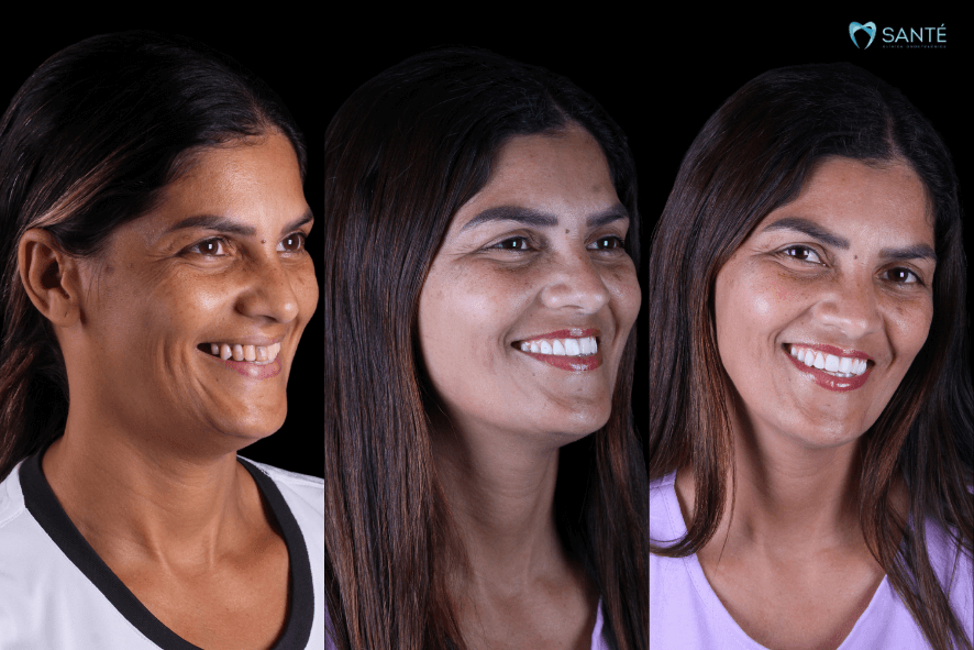 Carga imediata em Belo Horizonte BH 