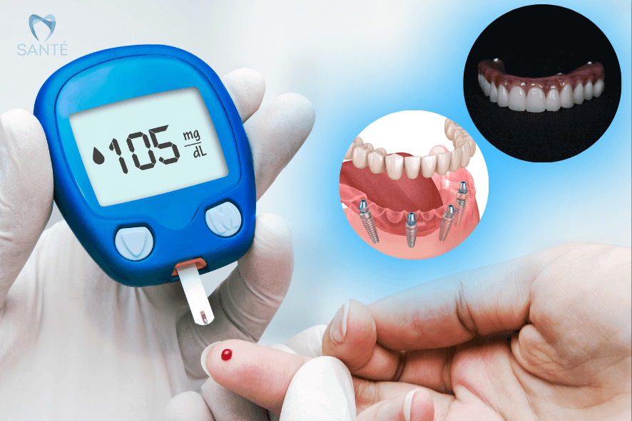 Diabético pode fazer Implante