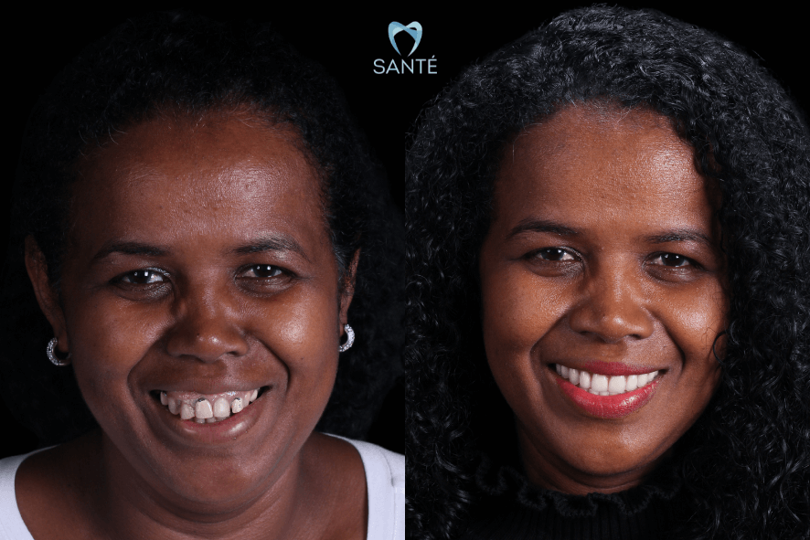 Extrair todos os dentes de uma vez