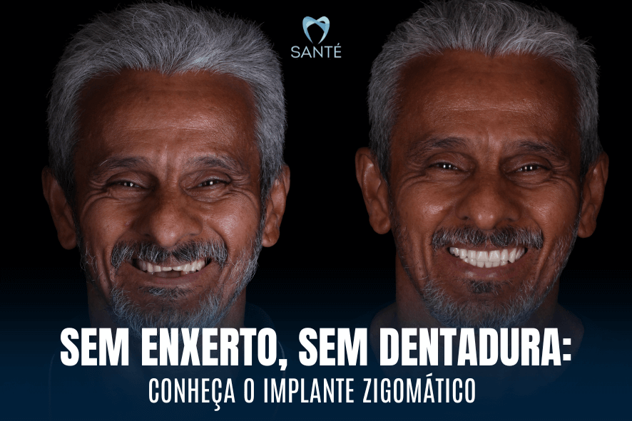 Implante zigomático em Belo Horizonte BH