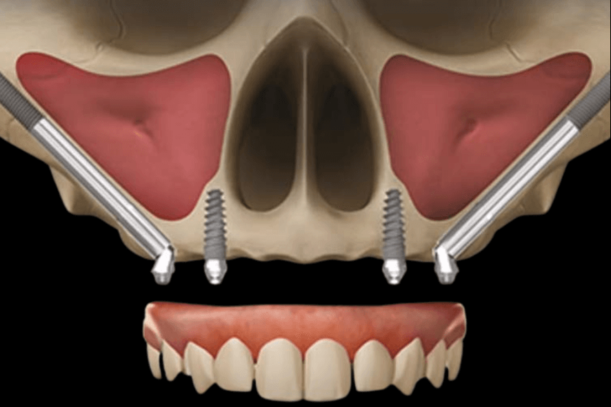 Levantamento de seio maxilar Bh