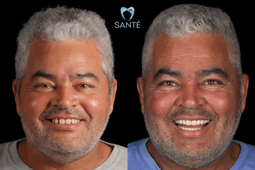 quanto custa implante zigomatico bh preço