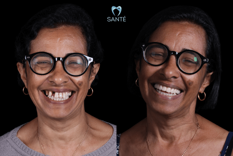 Dentes fixos carga imediata em Belo Horizonte