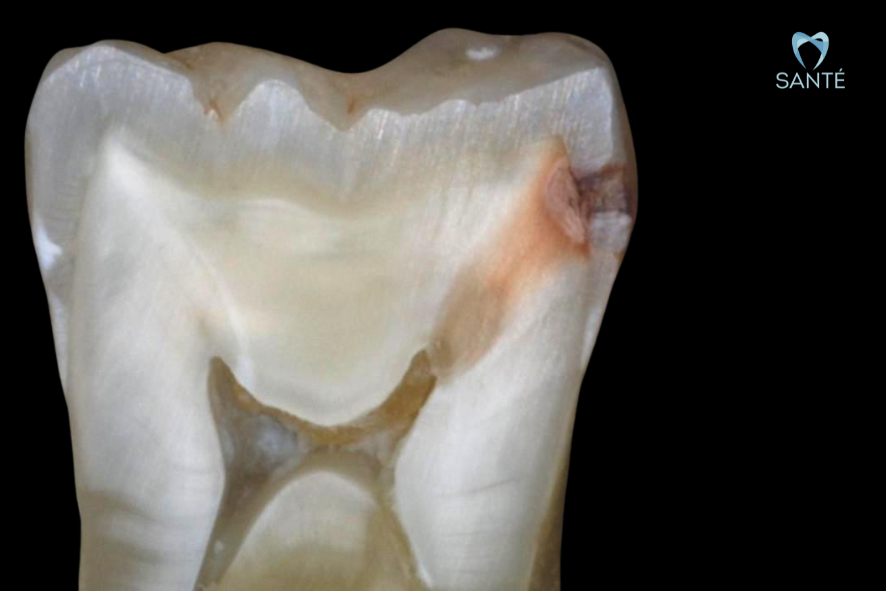 Dente de dente cárie