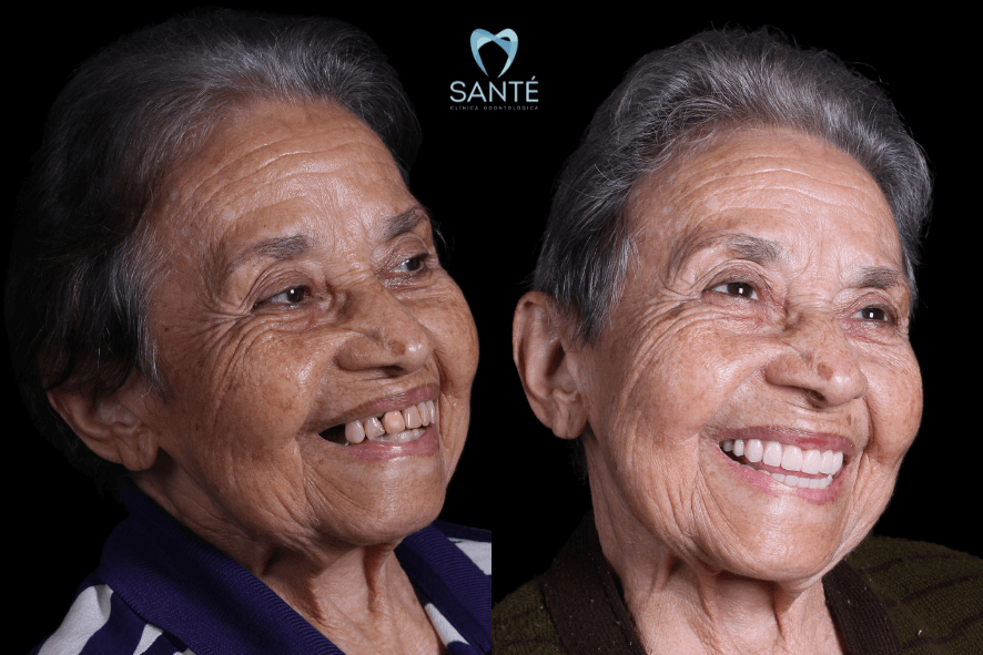 infarto, implante dentario e protese protocolo