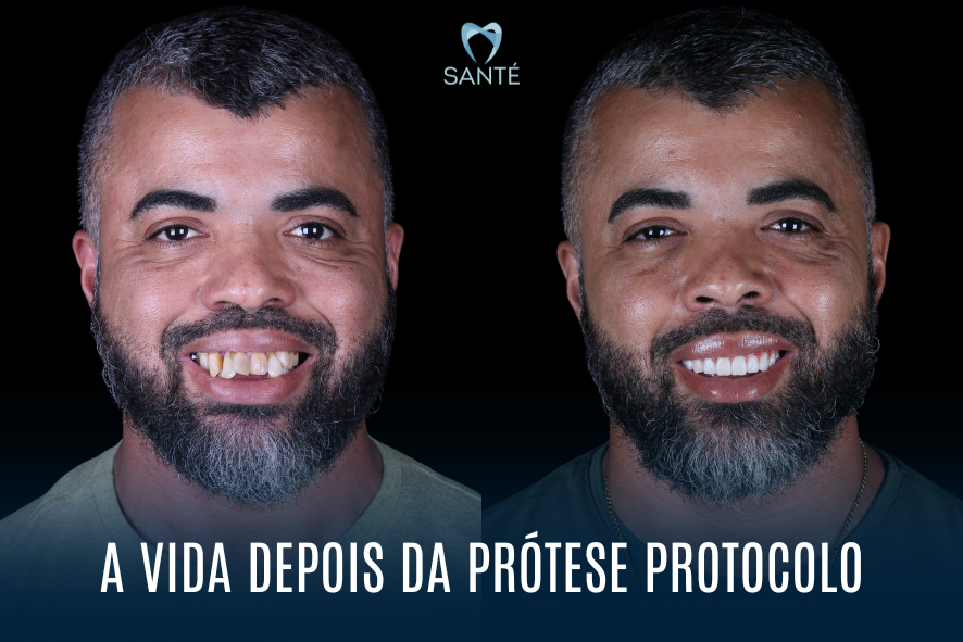 Prótese Protocolo Antes e Depois em BH - Nova Vida: Sucesso no Amor e no Trabalho