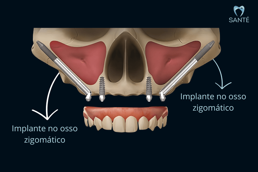 Esquema de implante no osso zigomático em BH, mostrando a fixação dos pinos longos no osso da face para sustentar a prótese protocolo.
