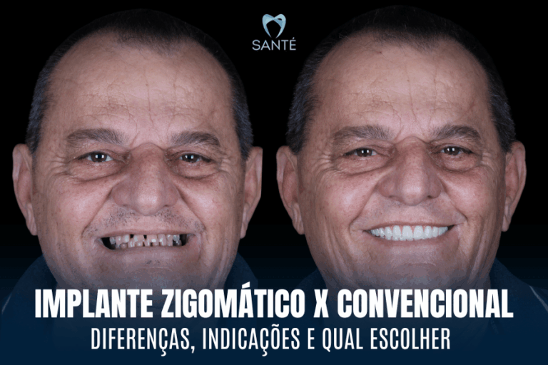 Antes e depois de homem sorrindo após implante zigomático em BH, técnica para quem tem perda óssea severa e deseja prótese protocolo.
