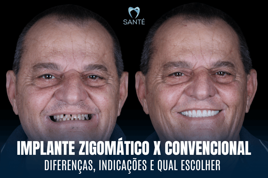 Antes e depois de homem sorrindo após implante zigomático em BH, técnica para quem tem perda óssea severa e deseja prótese protocolo.
