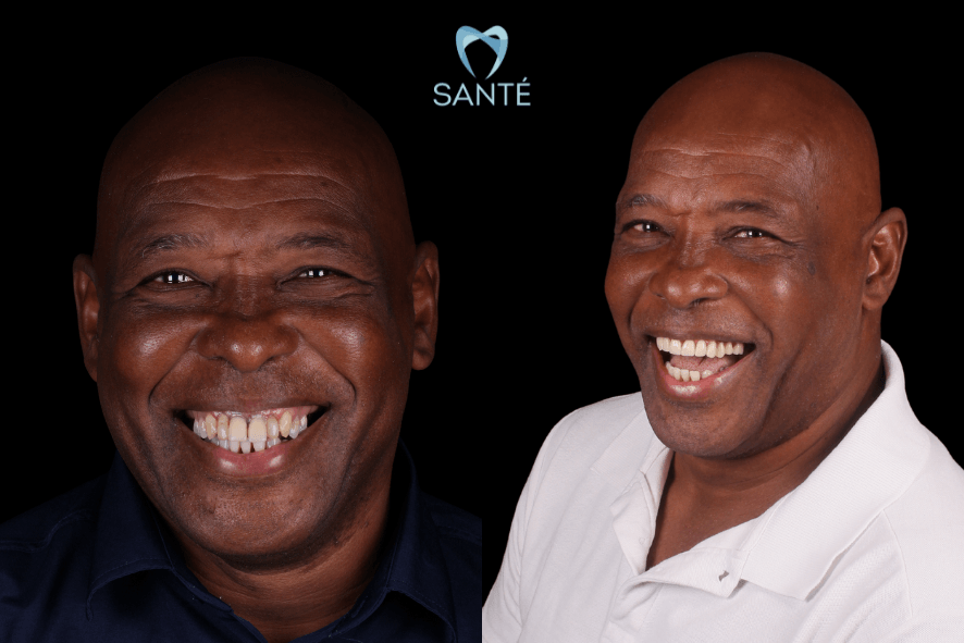 Reabilitação com implante zigomático em BH: homem sorrindo com prótese protocolo fixa após tratamento de perda óssea.