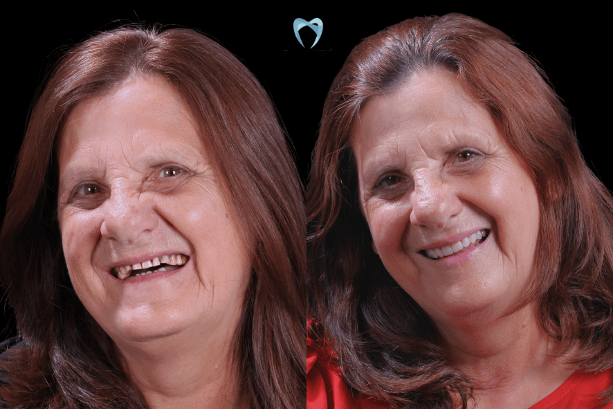 Antes e depois de mulher com sorriso renovado por implante zigomático em BH, tratando perda óssea severa com prótese protocolo fixa.
