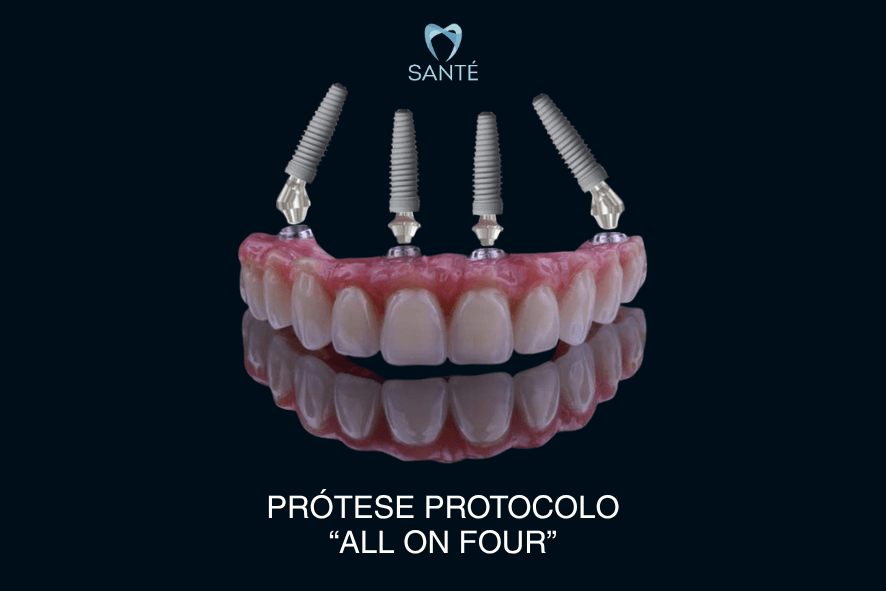 Ilustração técnica de prótese protocolo All-on-4 sobre quatro implantes dentários, técnica avançada disponível na Clínica Santé em BH.