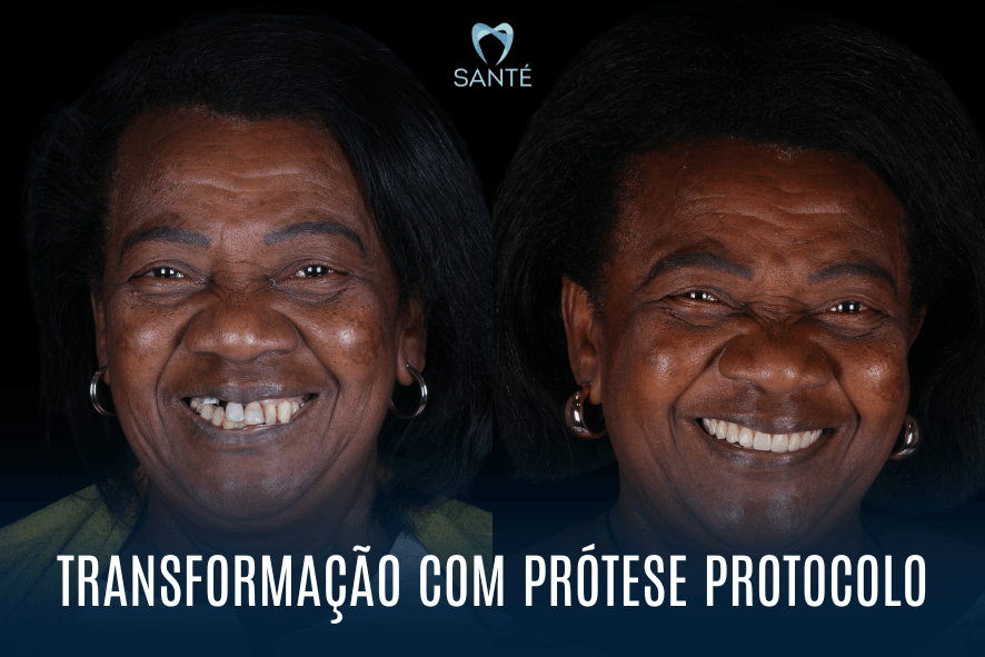 Antes e depois de transformação com prótese protocolo na Clínica Santé em BH, destacando o resultado estético e funcional de alta qualidade.