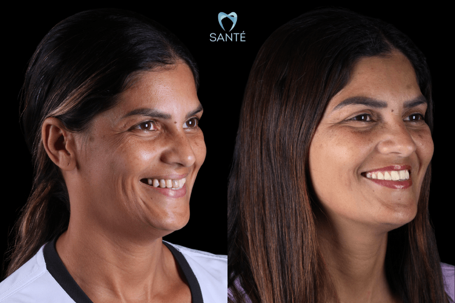 Antes e depois de tratamento com prótese protocolo em paciente feminina na Clínica Santé em BH, mostrando a melhora estética e funcional do sorriso.
