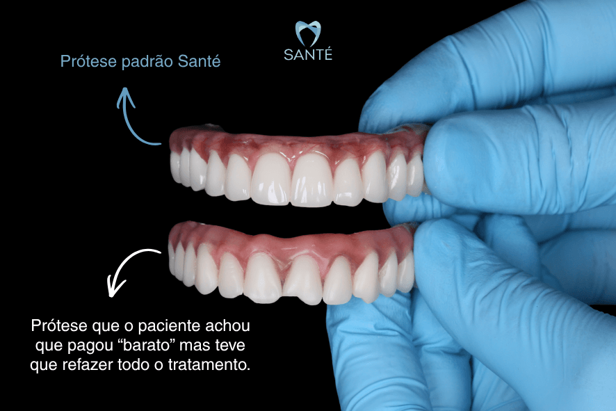 Comparativo entre prótese protocolo de alta qualidade da Clínica Santé BH e prótese de baixo custo com falhas estéticas e estruturais.