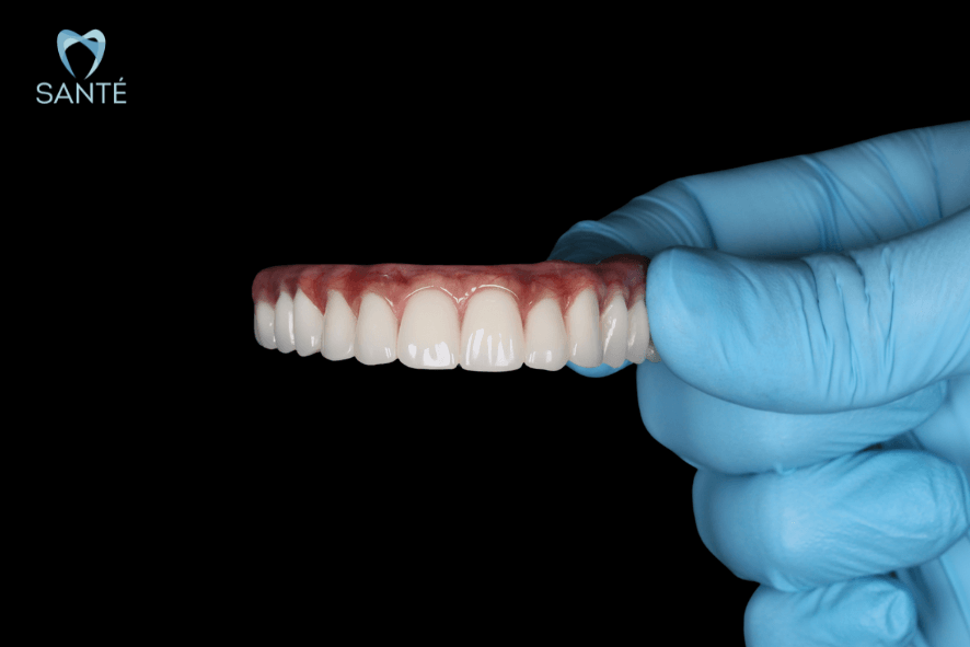 Prótese protocolo cerâmica sobre implantes com gengiva artificial estética, realizada pela Clínica Santé em BH para reabilitação oral feminina.